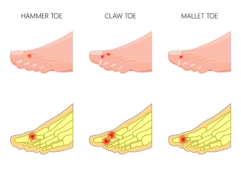 足の指の変形