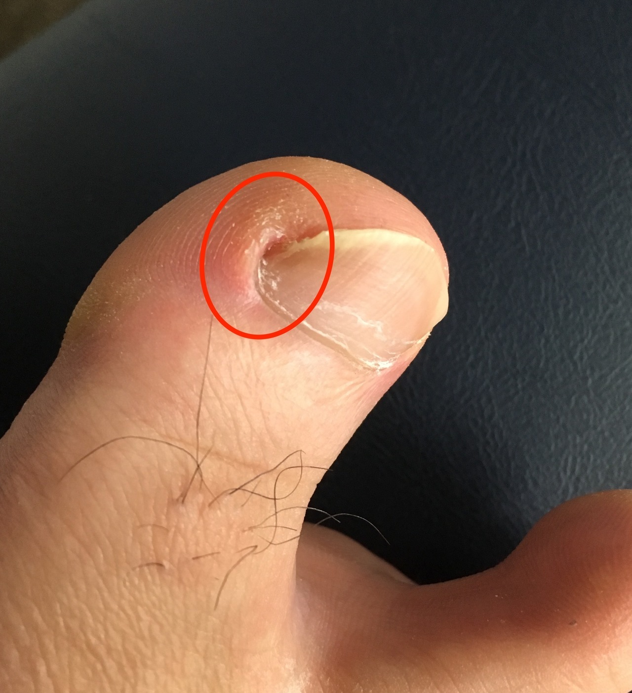 足爪の溝角質除去