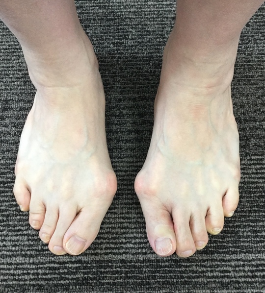 外反母趾の治療なら 足の専門 東京ポダイアトリークリニック 東京都港区