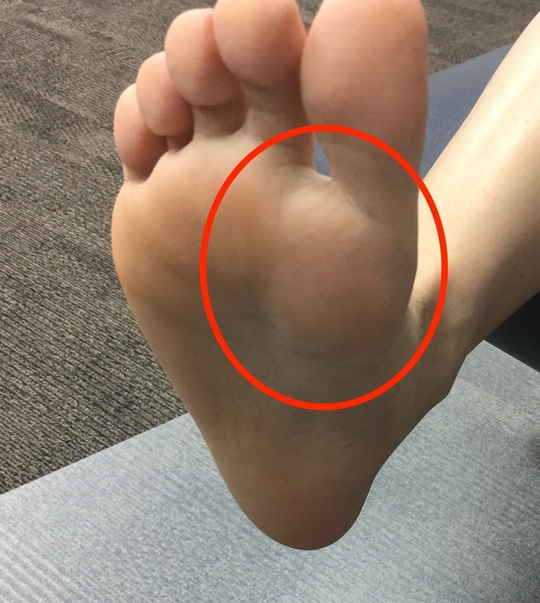 種子骨炎 足の親指の下の痛み 足の専門 東京ポダイアトリークリニック 東京都港区