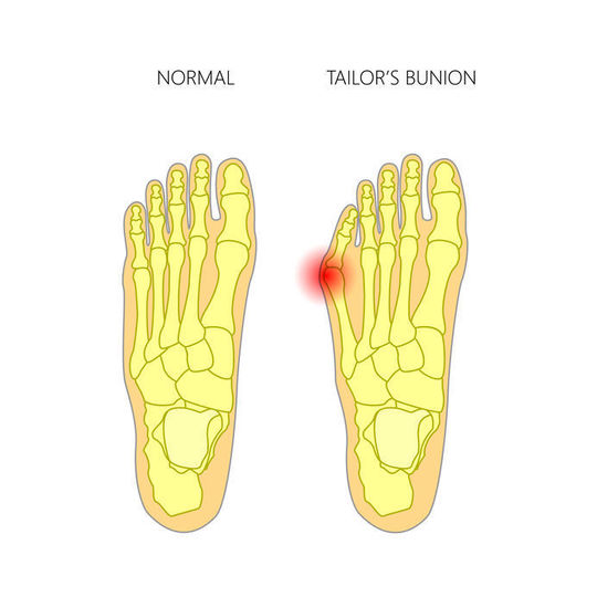 内反小趾の専門治療なら 足の専門 東京ポダイアトリークリニック 東京都港区